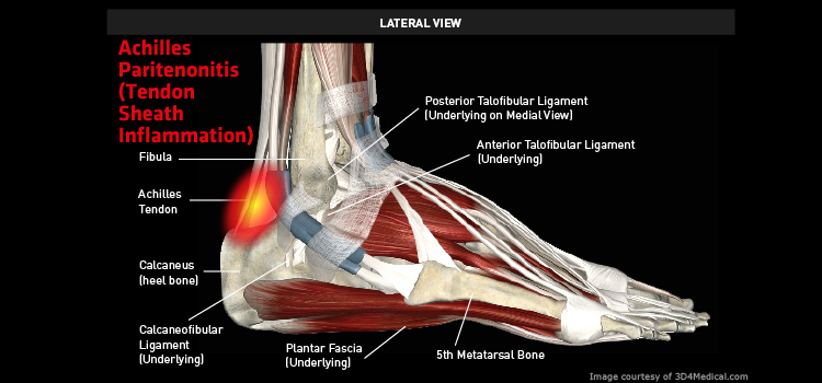 Ankle_AchillesParitenonitis_large