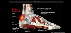 Ankle_AchillesTendinosis_large