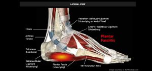 Ankle_PlantarFasciitis_large