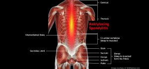 Back_AnklylosingSpondylitis_large