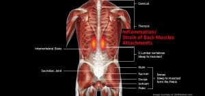 Back_InflammationStrainofBackMuscleAttachments_large