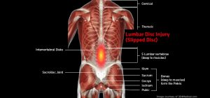 Back_LumbarDiscInjury_large