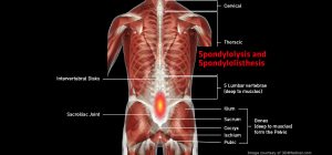 Back_SpondylolysisSpondylolisthesis_larg