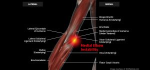 Elbow_MedialElbowInstability_Large