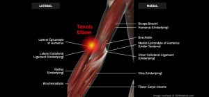 Elbow_TennisElbow_Large