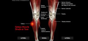 Legs_SoleusMuscleStrainorTear_large