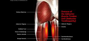 Thigh_AdductorTendinopathy_large