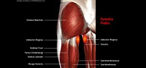 Thigh_OsteitisPubis_large