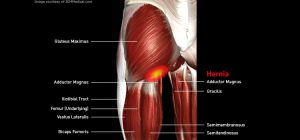 Thigh_hernia_large