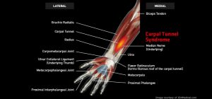 Wrist_CarpalTunnelSyndrome_large