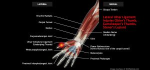 Wrist_LateralUlnerLigamentInjuries_large